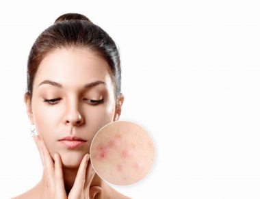Por que há cada vez mais mulheres adultas sofrendo com a temida acne?