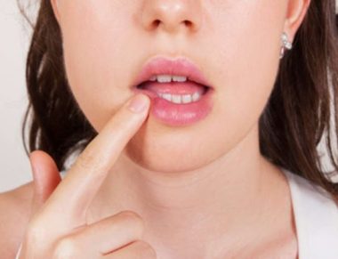 Herpes Labial: Conheça os Riscos Para Saúde, Causas e Sintomas da Doença.