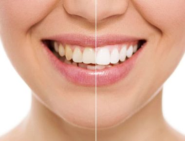 Saiba Tudo Sobre Lentes de Contato Dental. Verdades e Mitos, O Que é e Como Cuidar
