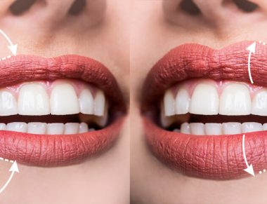 9 mitos e verdades sobre preenchimento labial